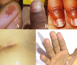 Kawaski Disease