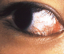 Indian Society of Kawasaki Disease