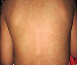Indian Society of Kawasaki Disease