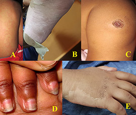 Indian Society of Kawasaki Disease